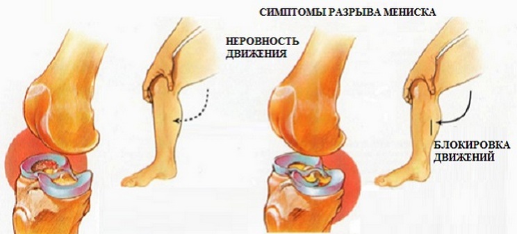 Мр признаки разрыва. Травма мениска колена симптомы. Разрыв мениска коленного сустава симптомы. Симптомы повреждения менисков коленного сустава. Повреждение мениска колена симптомы.