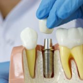 Имплантация зубов, как проходит процедура, плюсы и минусы имплантации